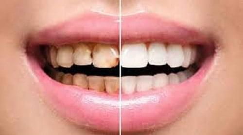 طرق طبيعية للتخلص من آلام الأسنان