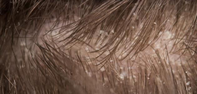 أسهل الطرق للتخلص من قشرة الشعر